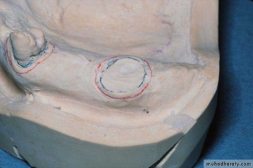 Immediate Denture