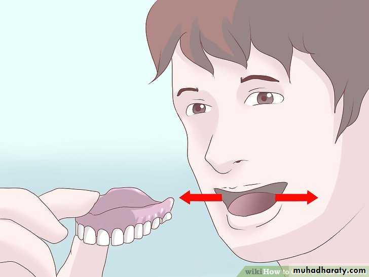 Immediate Denture