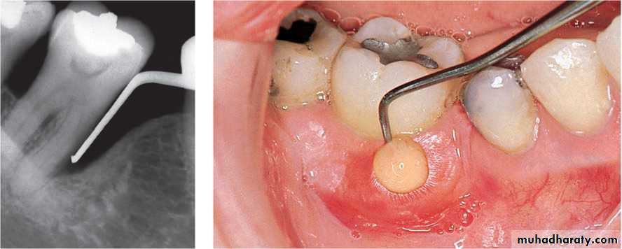 Immediate Denture