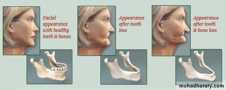 Immediate Denture