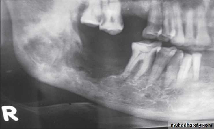 Immediate Denture