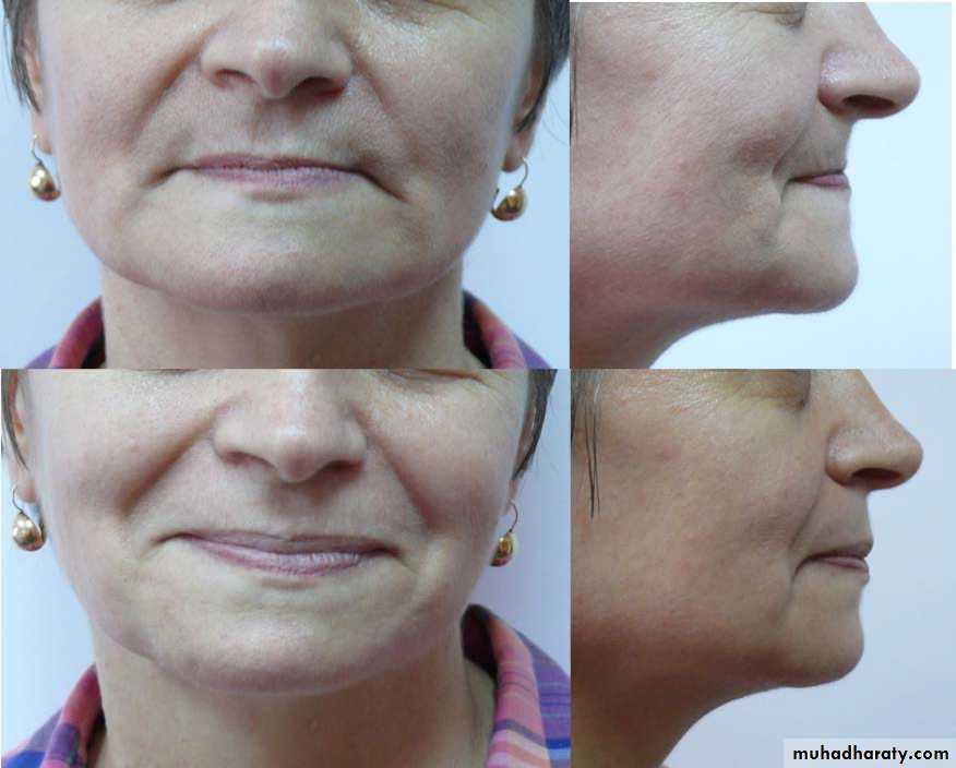 Immediate Denture