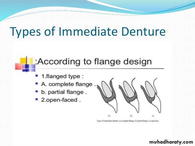 Immediate Denture