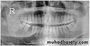 osteomylitis
