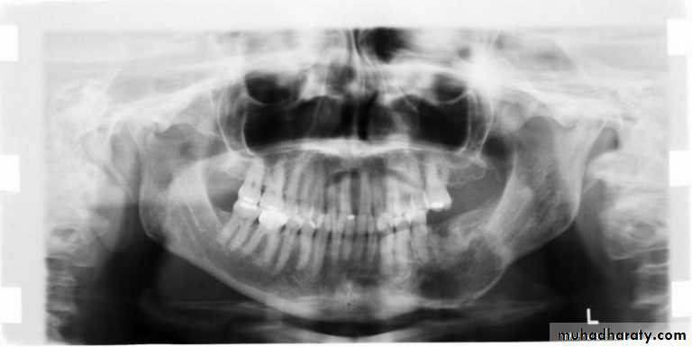 osteomylitis
