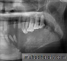 osteomylitis