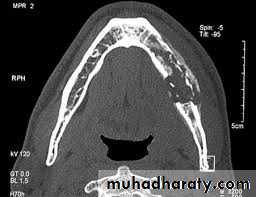 osteomylitis