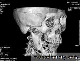 osteomylitis