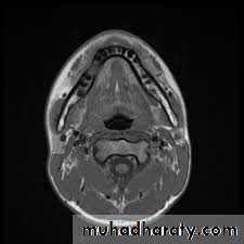 osteomylitis