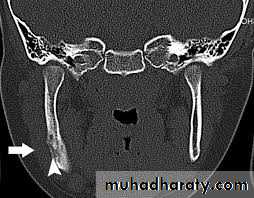 osteomylitis