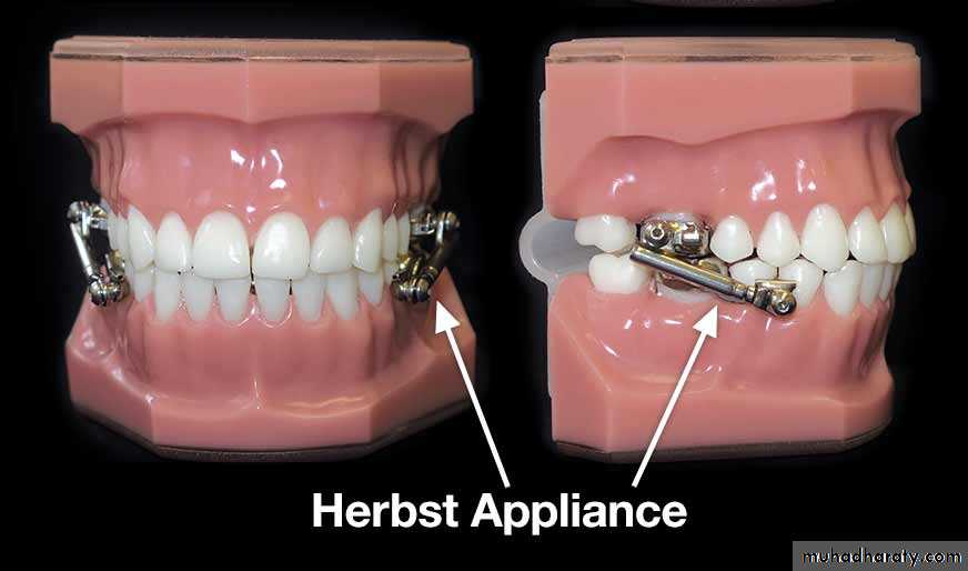 functional appliance