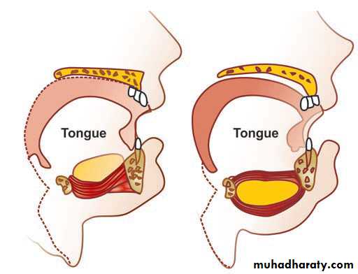 benign tumor