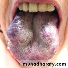 benign tumor