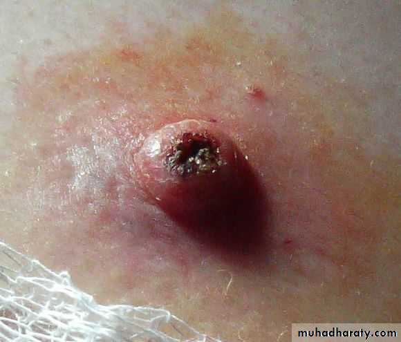 benign tumor