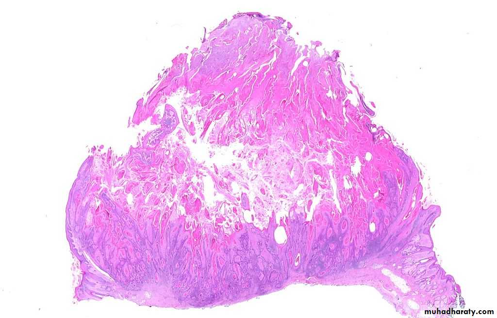 benign tumor
