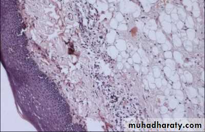 benign tumor