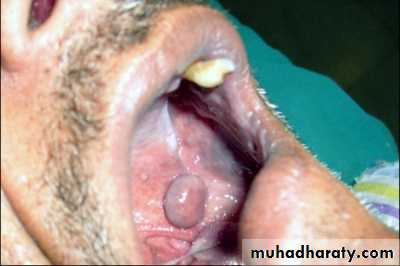 benign tumor