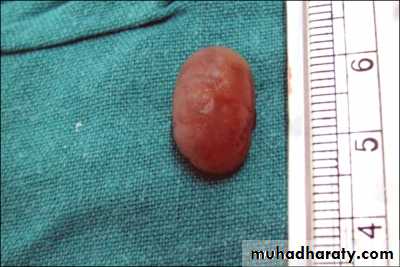 benign tumor