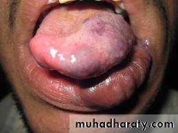 benign tumor