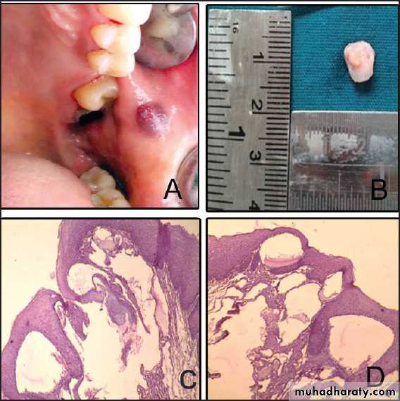 benign tumor