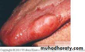benign tumor