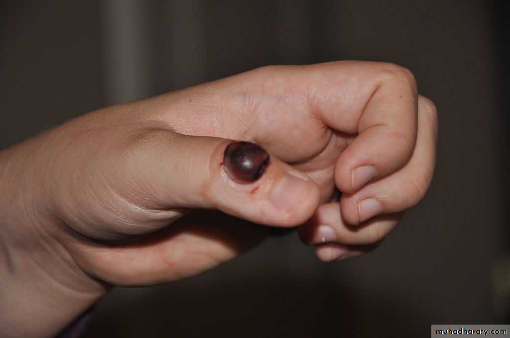 benign tumor