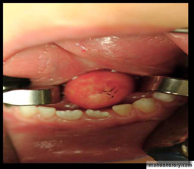 benign tumor