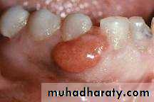 benign tumor