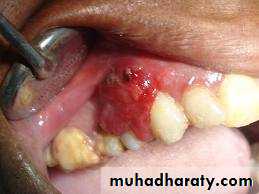 benign tumor