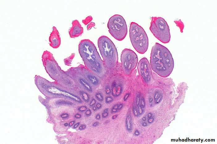 benign tumor