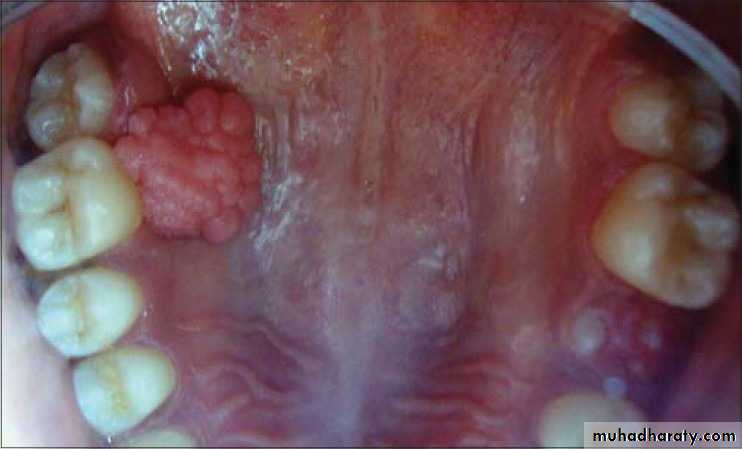 benign tumor