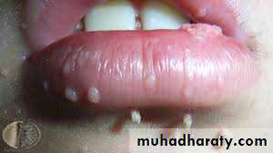 benign tumor