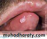 benign tumor