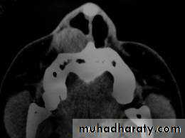 benign tumor