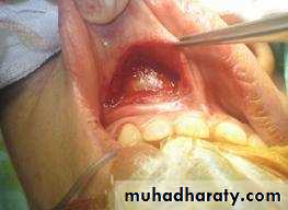 benign tumor