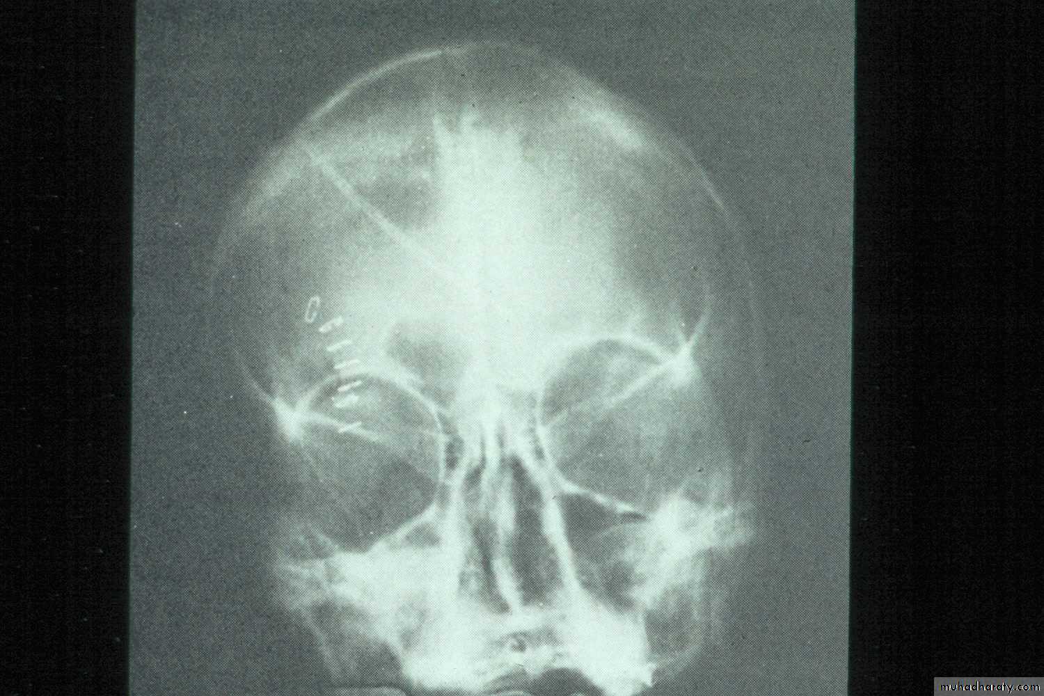 maxillary sinus disease