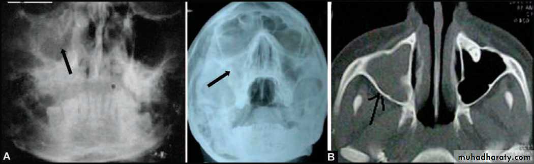 maxillary sinus disease