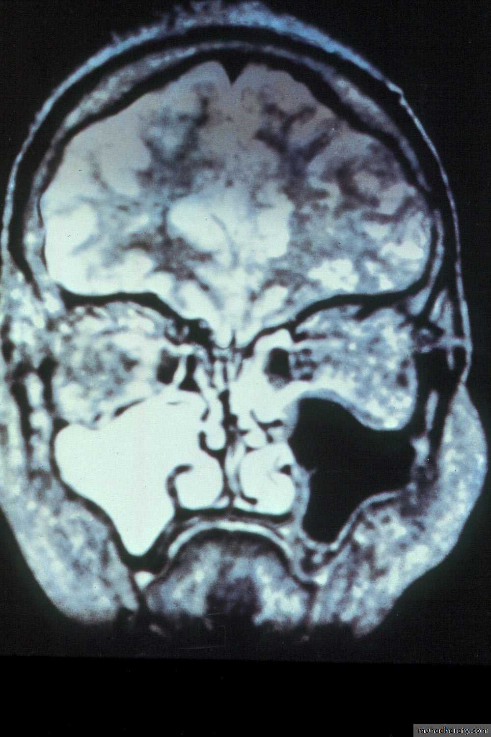 maxillary sinus disease