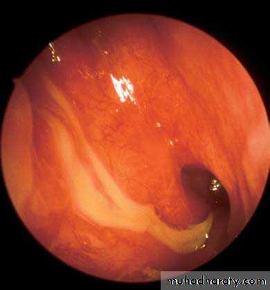 maxillary sinus disease