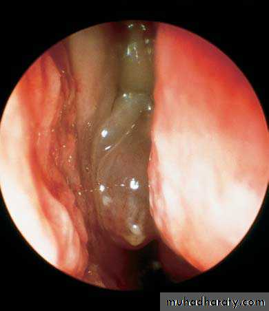 maxillary sinus disease