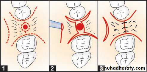 maxillary sinus disease