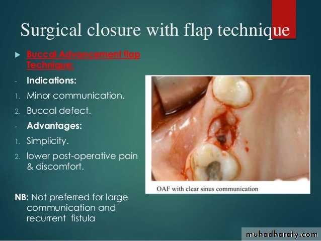maxillary sinus disease