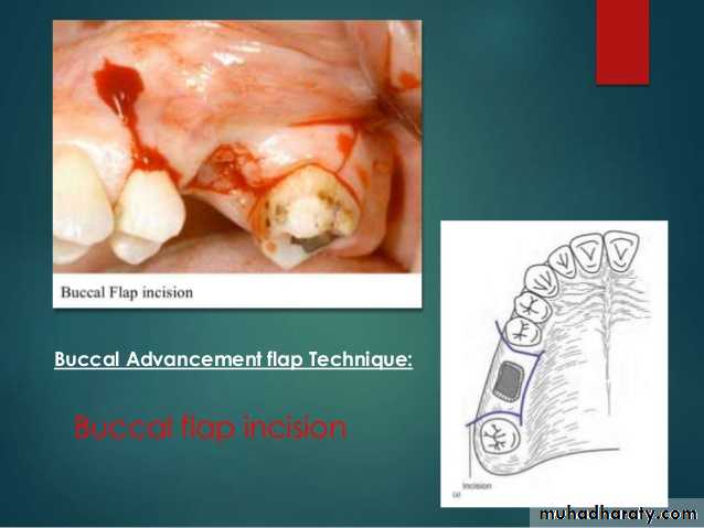 maxillary sinus disease