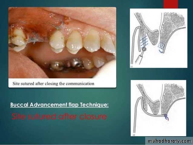 maxillary sinus disease