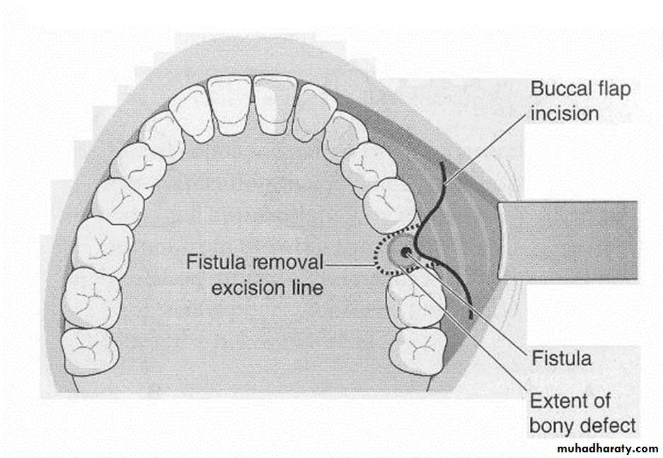 maxillary sinus disease