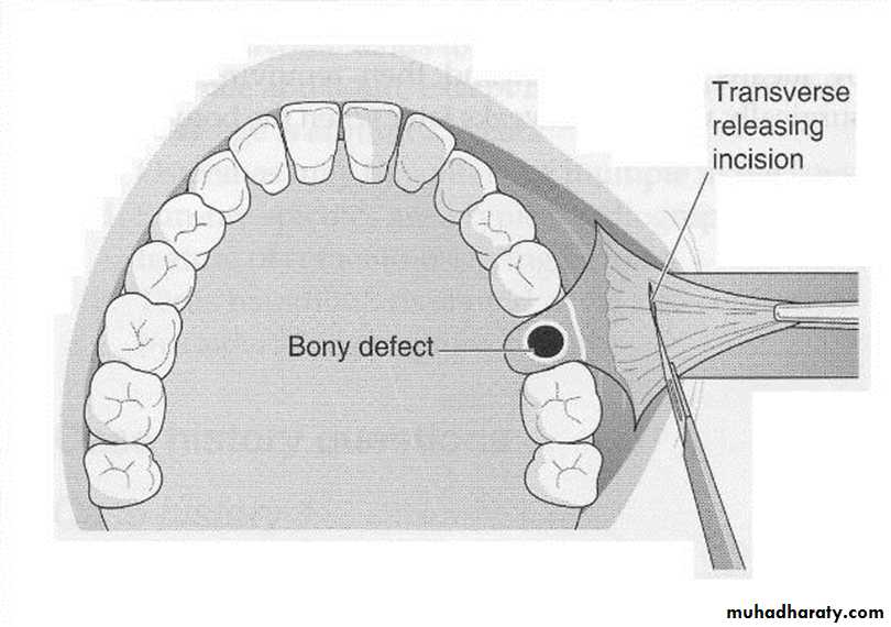 maxillary sinus disease
