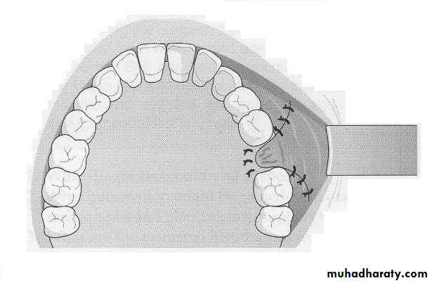 maxillary sinus disease