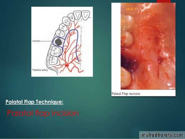 maxillary sinus disease