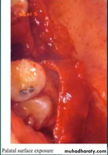 maxillary sinus disease