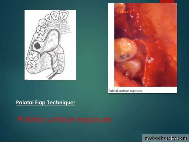 maxillary sinus disease